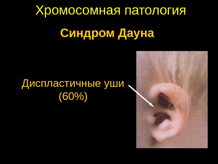 Хромосомная патология Диспластичные уши (60) Синдром Дауна 