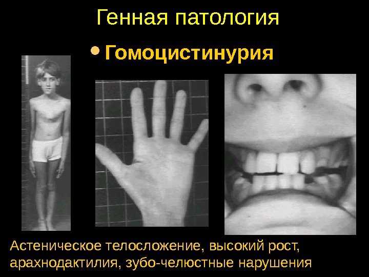 Генная патология Гомоцистинурия Астеническое телосложение, высокий рост, арахнодактилия, зубо-челюстные нарушения 
