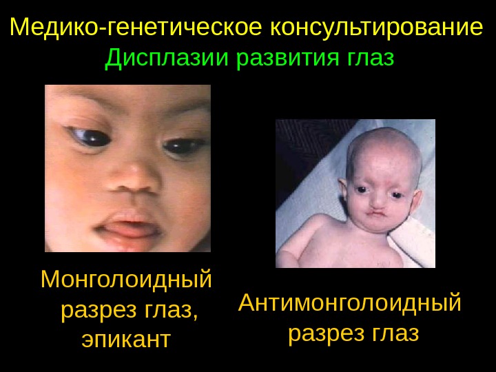 Медико-генетическое консультирование Дисплазии развития глаз Монголоидный разрез глаз, эпикант Антимонголоидный разрез глаз 