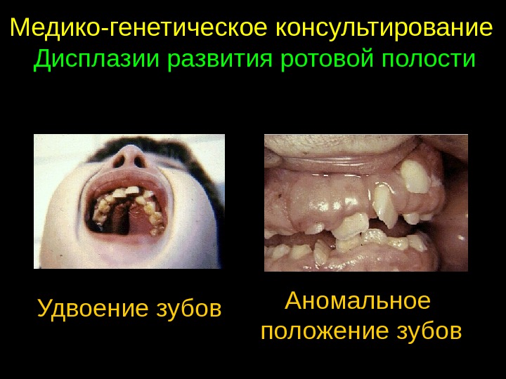 Медико-генетическое консультирование Дисплазии развития ротовой полости Удвоение зубов Аномальное положение зубов 
