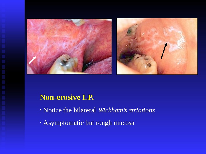 Non-erosive LP.  •  Notice the bilateral Wickham’s striations •  Asymptomatic but rough mucosa