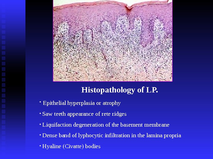 Histopathology of LP.  •  Epithelial hyperplasia or atrophy •  Saw teeth appearance of