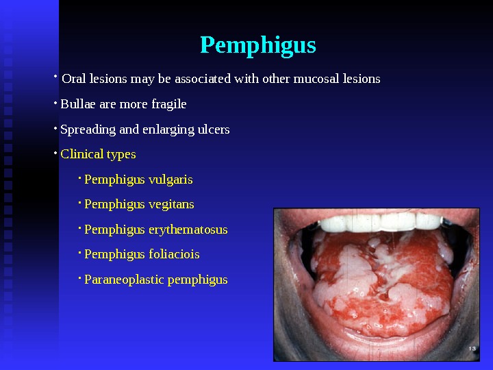 Pemphigus •  Oral lesions may be associated with other mucosal lesions •  Bullae are