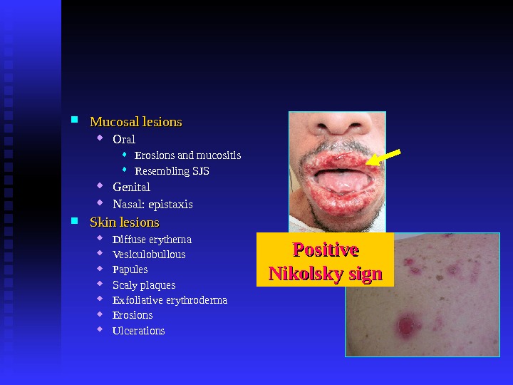  Mucosal lesions Oral Erosions and mucositis Resembling SJS Genital Nasal: epistaxis Skin lesions Diffuse erythema