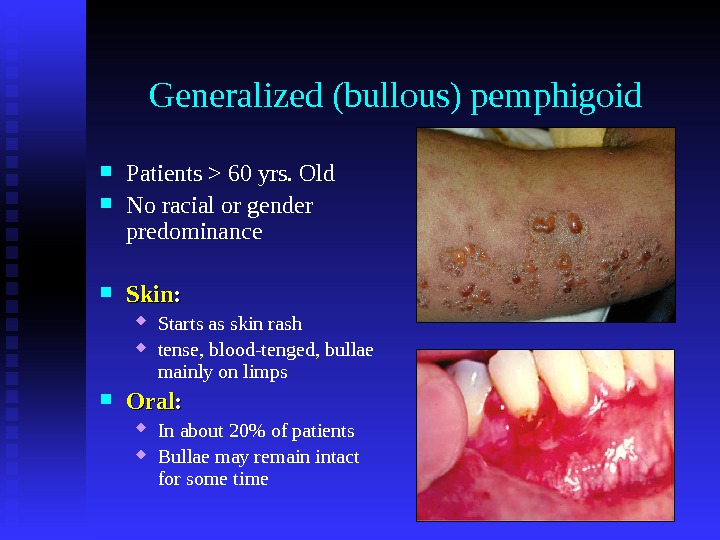 Generalized (bullous) pemphigoid Patients  60 yrs. Old No racial or gender predominance Skin : :