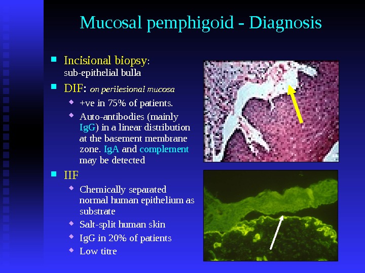 Mucosal pemphigoid - Diagnosis Incisional biopsy :  sub-epithelial bulla DIF :  on perilesional mucosa