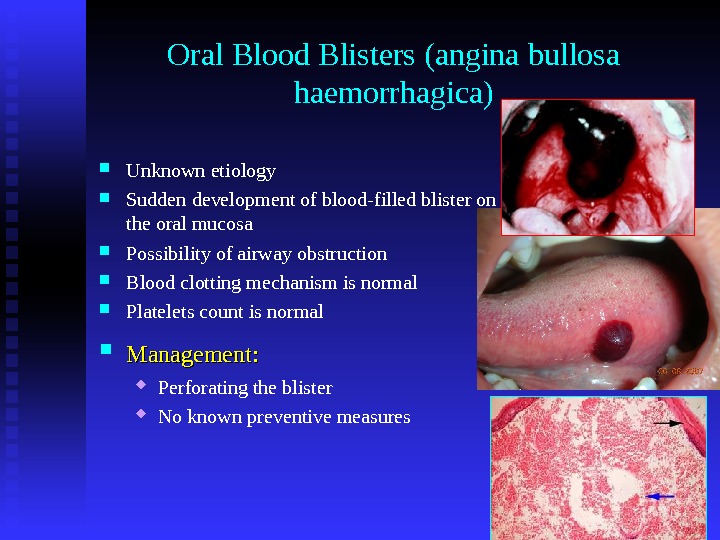 Oral Blood Blisters (angina bullosa haemorrhagica) Unknown etiology Sudden development of blood-filled blister on the oral