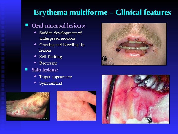 Erythema multiforme – Clinical features Oral mucosal lesions:  Sudden development of widespread erosions  Crusting