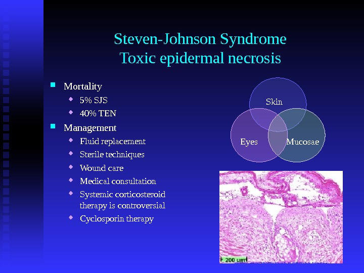 Steven-Johnson Syndrome Toxic epidermal necrosis Mortality 5 SJS 40 TEN Management Fluid replacement Sterile techniques Wound