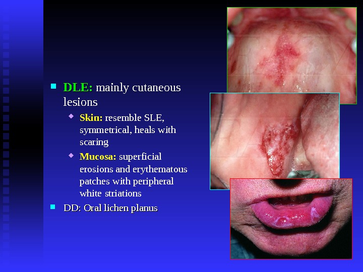  DLE:  mainly cutaneous lesions Skin:  resemble SLE,  symmetrical, heals with scaring Mucosa: