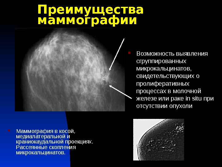 Преимущества маммографии Маммография в косой,  медиалатеральной и краниокаудальной проекциях.  Рассеянные скопления микрокальцинатов.  Возможность