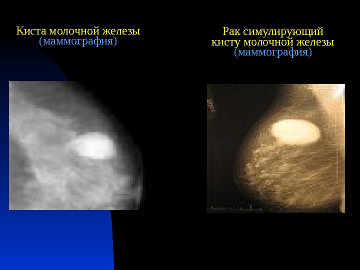 Киста молочной железы  (маммография) Рак симулирующий кисту молочной железы  (маммография) 
