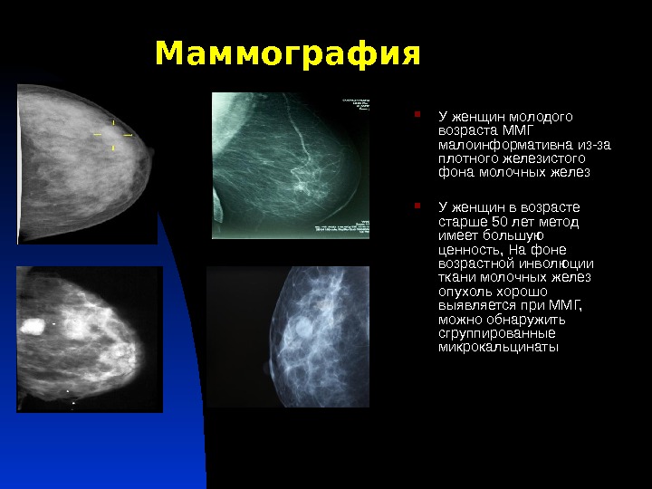 Маммография  У женщин молодого возраста ММГ малоинформативна из-за плотного железистого фона молочных желез У женщин