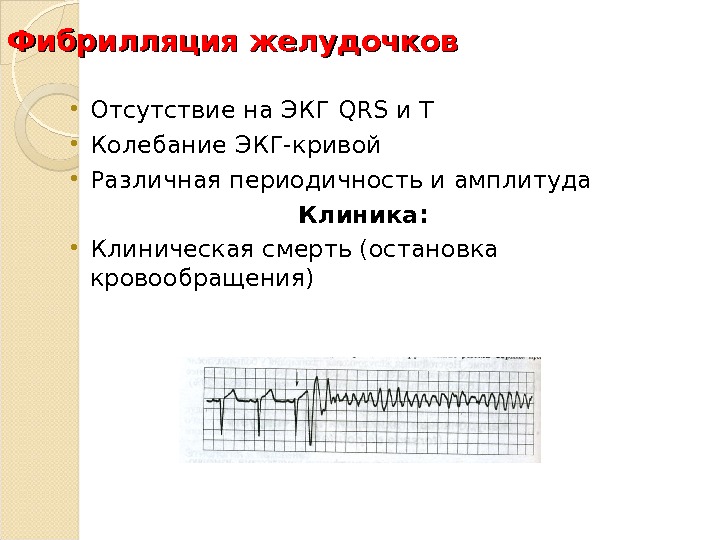 Фибрилляция желудочков • Отсутствие на ЭКГ QRS и T • Колебание ЭКГ-кривой • Различная периодичность и