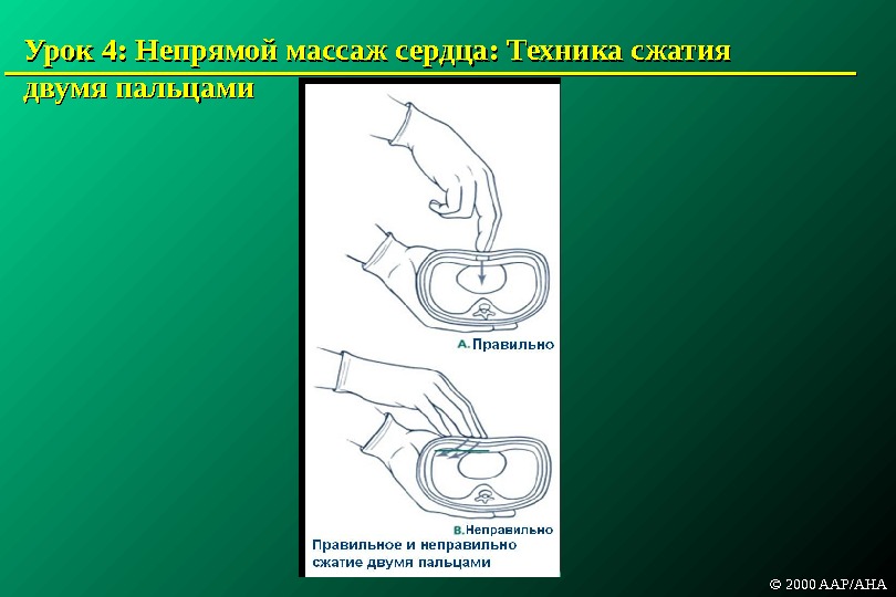 Урок 4:  Непрямой массаж сердца : :  Техника сжатия двумя пальцами © 2000 AAP/AHA