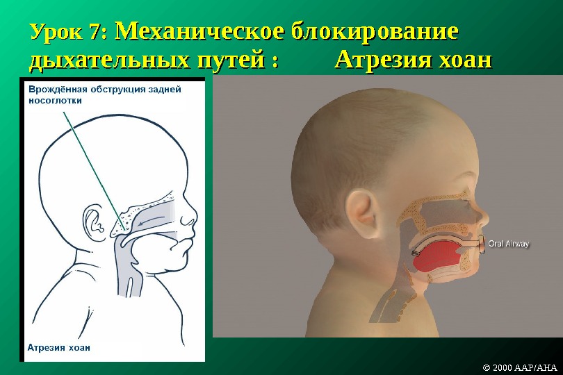 Урок 7:  Механическое блокирование дыхательных путей :  : Атрезия хоан © 2000 AAP/AHA 
