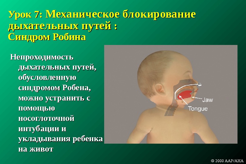Урок 7:  Механическое блокирование дыхательных путей :  :  Синдром Робина Непроходимость дыхательных путей,
