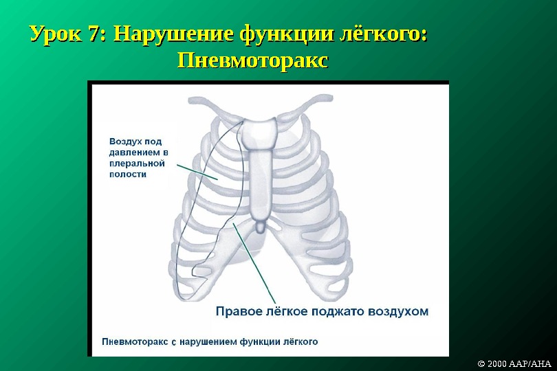 Урок 7:  Нарушение функции лёгкого : :  Пневмоторакс © 2000 AAP/AHA 
