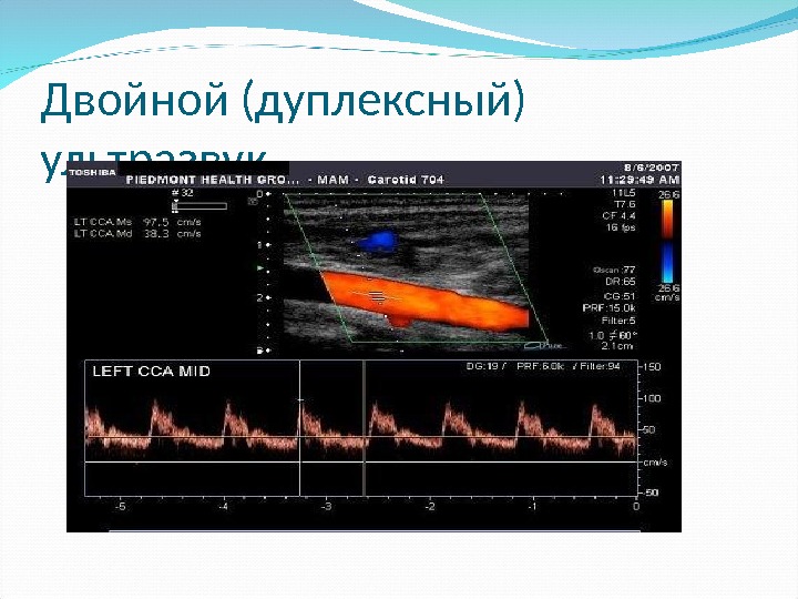 Двойной (дуплексный) ультразвук 