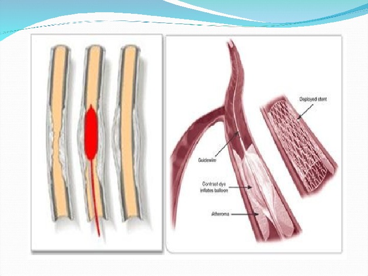 Атеросклероз сосудов нижних конечностей презентация