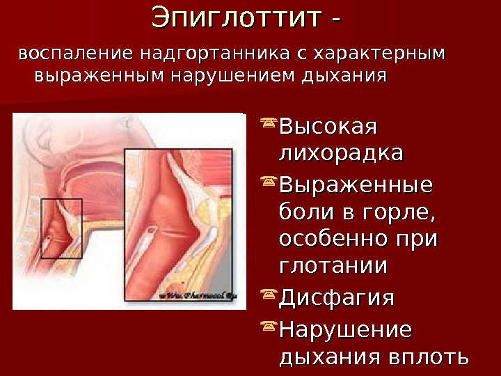 Эпиглоттит - воспаление надгортанника с характерным выраженным нарушением дыхания Высокая лихорадка Выраженные боли в горле, 