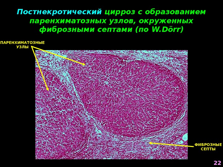 Постнекротический цирроз с образованием паренхиматозных узлов, окруженных фиброзными септами (по W. Dörr ) ПАРЕНХИМАТОЗНЫЕ УЗЛЫ ФИБРОЗНЫЕ