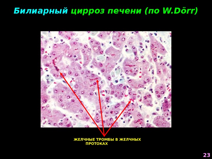 Билиарный цирроз печени (по W. Dörr ) ЖЕЛЧНЫЕ ТРОМБЫ В ЖЕЛЧНЫХ ПРОТОКАХ 23 