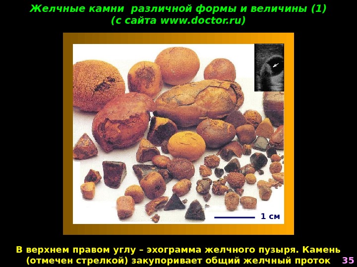 Желчные камни различной формы и величины (1) (с сайта www. doctor. ru) 351 см В верхнем