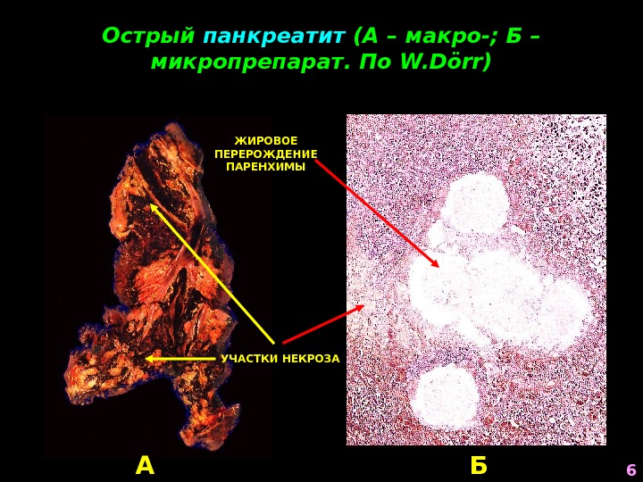 Острый панкреатит (А – макро-; Б – микропрепарат. По W. Dörr ) А БУЧАСТКИ НЕКРОЗА ЖИРОВОЕ