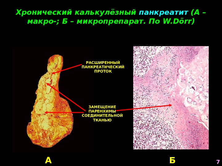 Хронический калькулёзный панкреатит (А – макро-; Б – микропрепарат. По W. Dörr ) А БЗАМЕЩЕНИЕ ПАРЕНХИМЫ
