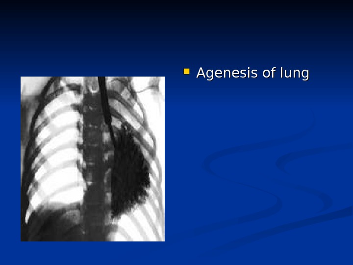  Agenesis of lung 