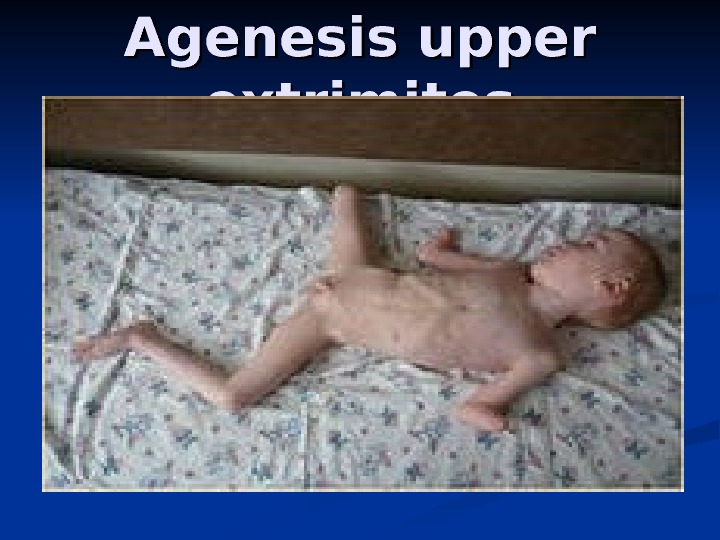 Agenesis upper extrimites 