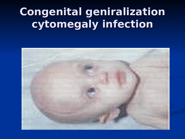 Congenital geniralization cytomegaly infection 