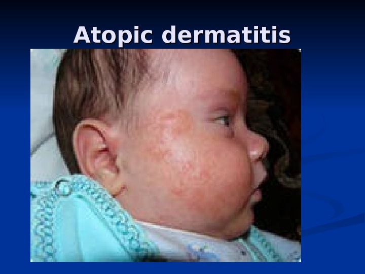 Atopic dermatitis 