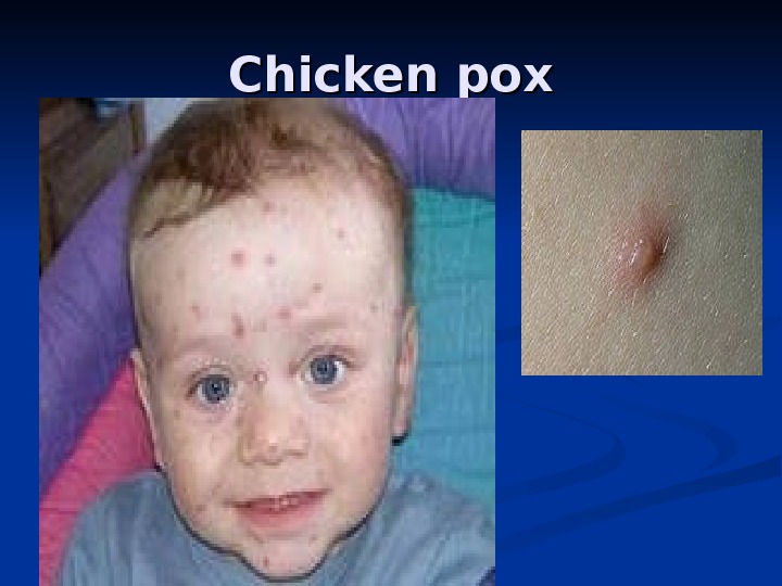 Chicken pox 