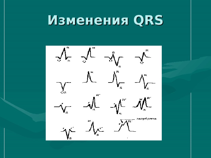 Изменения QRS 