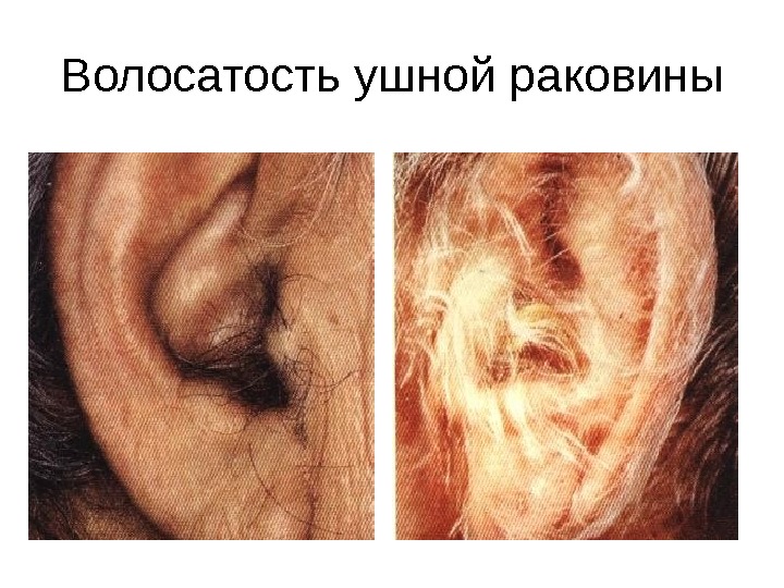 Волосатость ушной раковины 