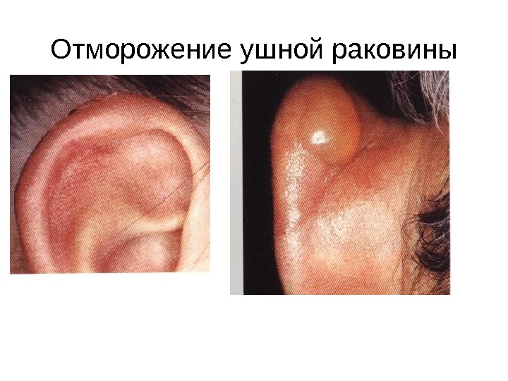 Отморожение ушной раковины 
