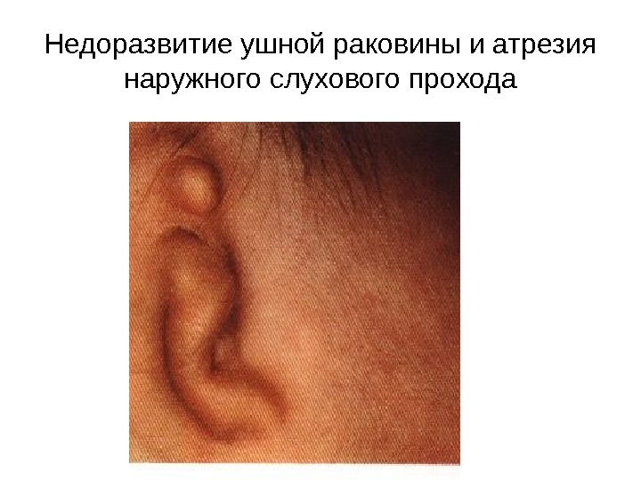 Недоразвитие ушной раковины и атрезия наружного слухового прохода 