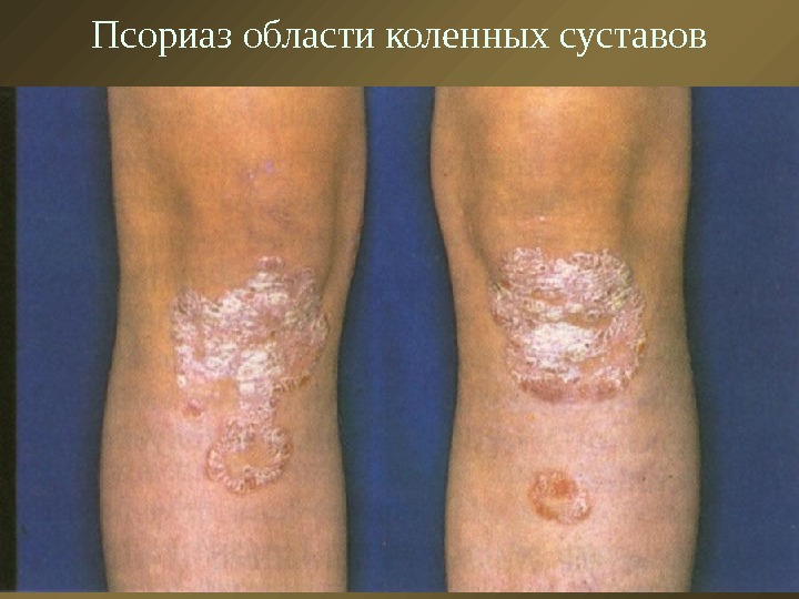 Псориаз области коленных суставов 