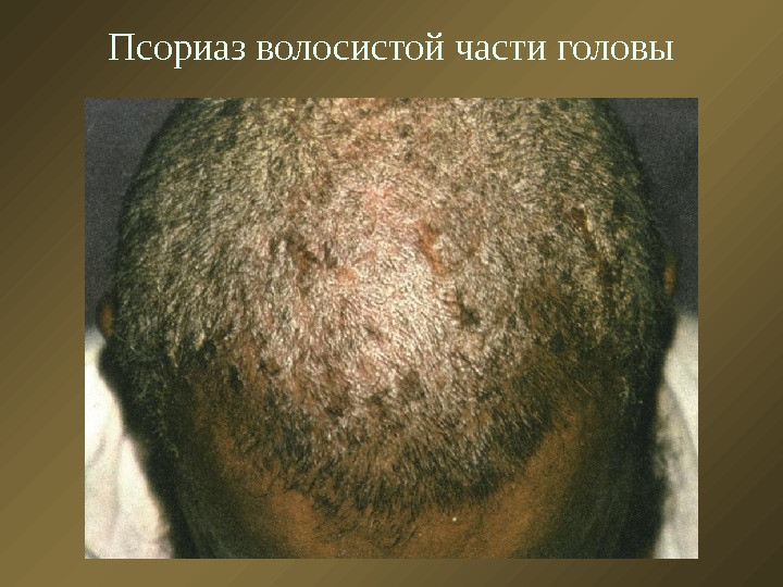 Псориаз волосистой части головы 