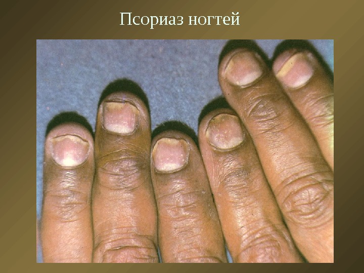 Псориаз ногтей 