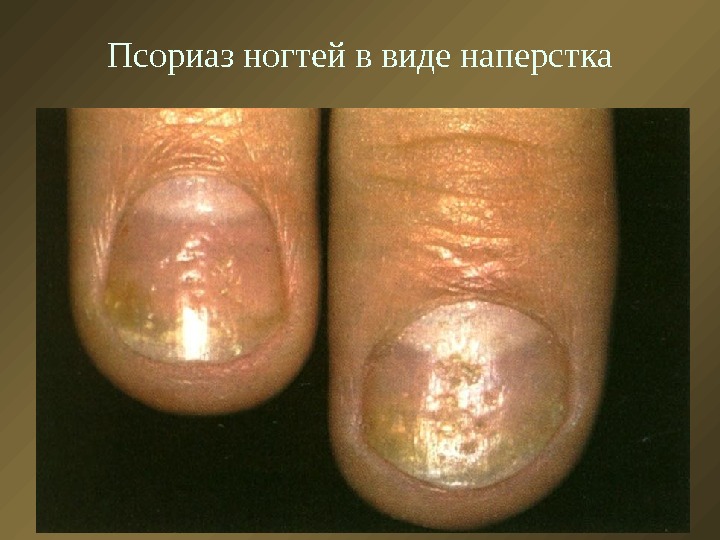 Псориаз ногтей в виде наперстка 