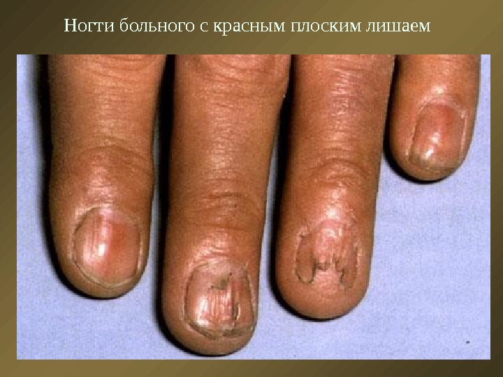 Ногти больного с красным плоским лишаем 