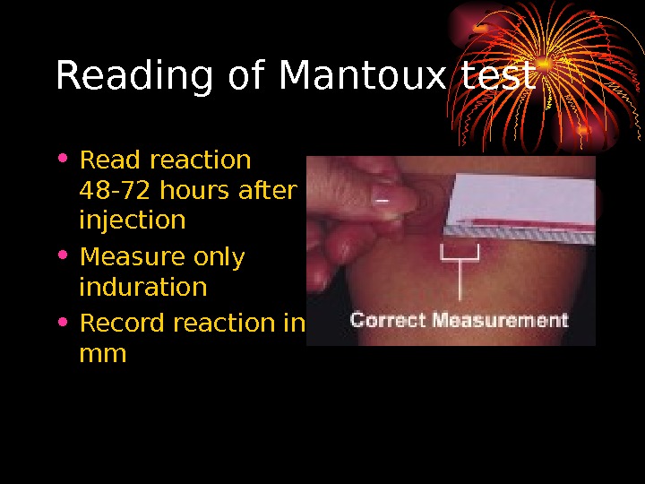   Reading of Mantoux test • Read reaction 48 -72 hours after injection • Measure