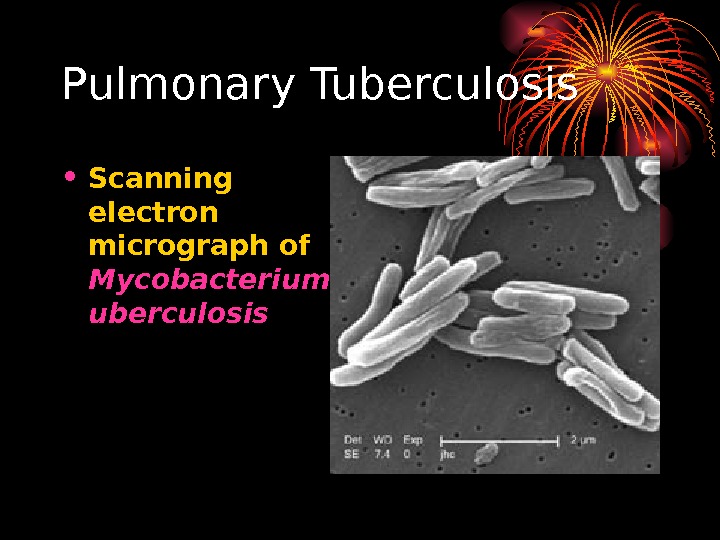  Pulmonary Tuberculosis • Scanning electron micrograph of Mycobacterium t uberculosis 