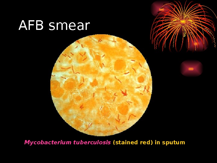   AFB smear Mycobacterium tuberculosis (stained red) in sputum 