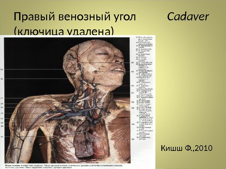 Правый венозный угол  Cadaver ( ключица удалена) Кишш Ф. , 2010 
