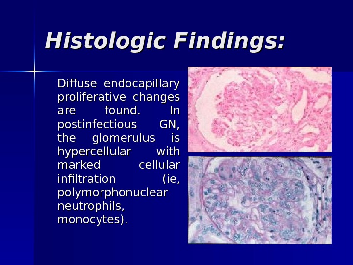 Histologic Findings: Diffuse endocapillary proliferative changes are found.  In postinfectious GN,  the glomerulus is