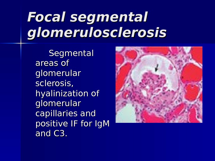 Focal segmental glomerulosclerosis  Segmental areas of glomerular sclerosis,  hyalinization of glomerular capillaries and positive